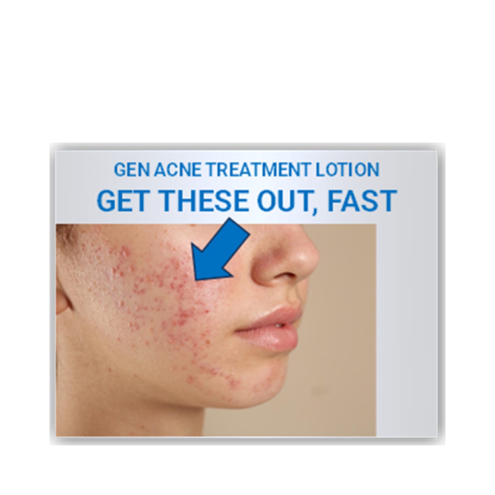 GEN Acne Treatment | best pimple patch lotion | salicylic acid body wash | non comedogenic acne treatment | dark spot remover | best moisturizer for oily skin