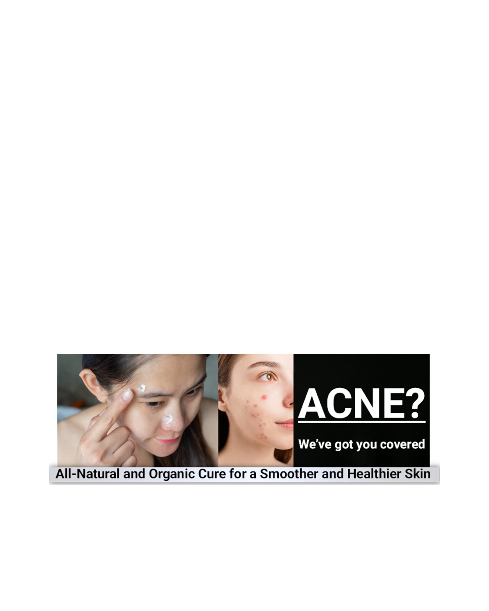 dark spot remover, acne treatment cream, compare to pimple patch, skincare for oily skin, moisturizer for oily skin, benzoyl peroxide, accutane, oily skin cream
