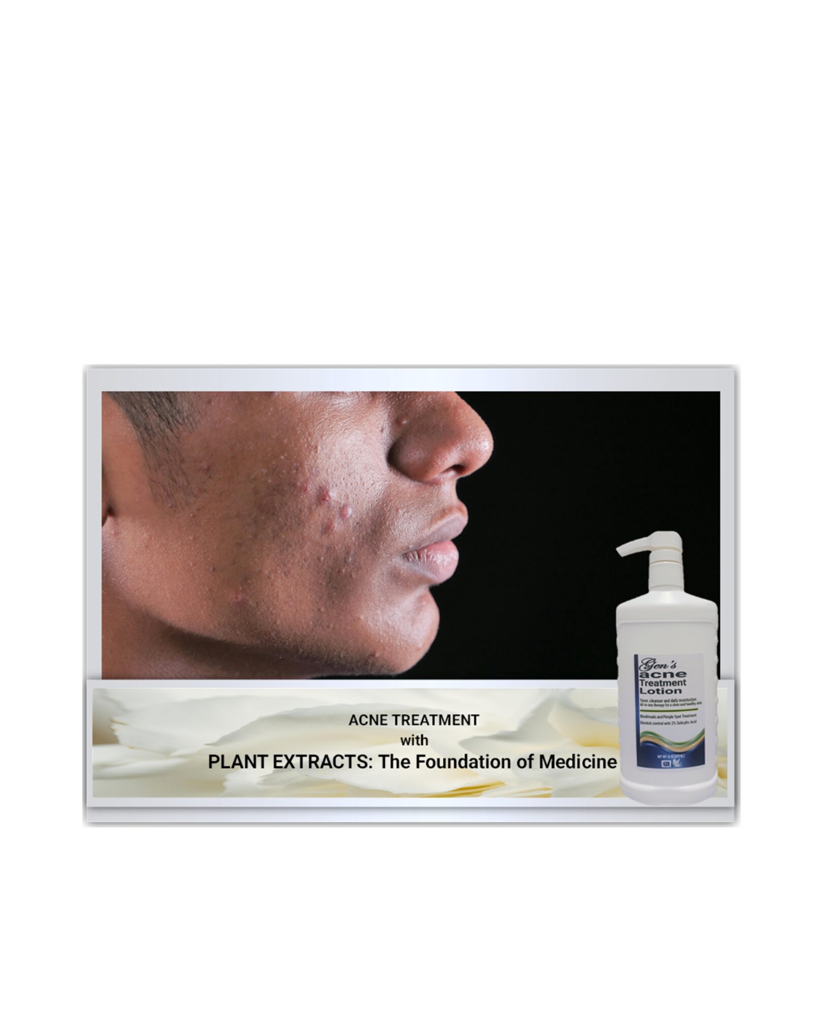 dark spot remover, acne treatment cream, compare to pimple patch, skincare for oily skin, moisturizer for oily skin, benzoyl peroxide, accutane, oily skin cream